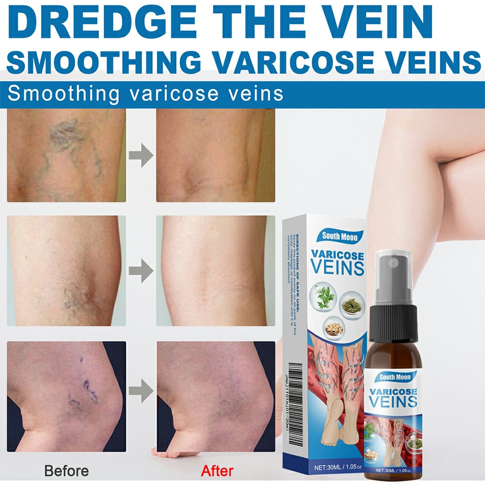 Varicose Veins Treatment Spray 30ml – Advanced Relief for Spider Veins, Leg Pain & Swelling - Image 2