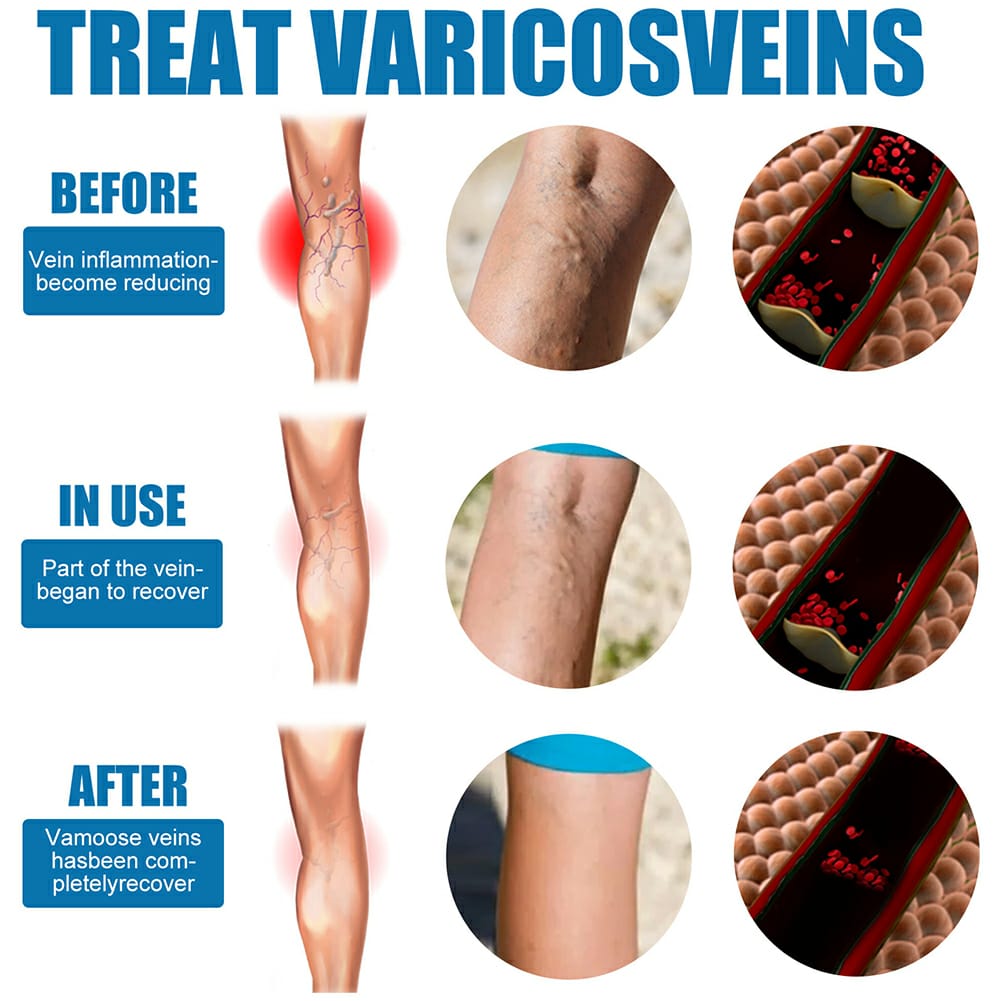 Varicose Veins Treatment Spray 30ml – Advanced Relief for Spider Veins, Leg Pain & Swelling - Image 3
